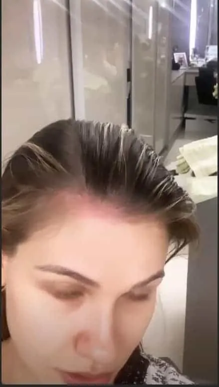 Andressa Suita mostra queimaduras no couro cabeludo