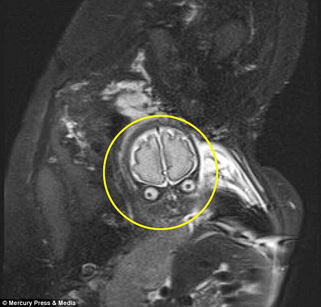 Imagem da ressonância magnética do pequeno Lucas com 30 semanas de gestação