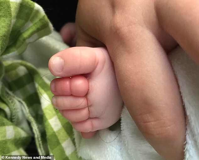 Foto do pé do bebê Ezra quando sua mãe descobriu o fio de cabelo