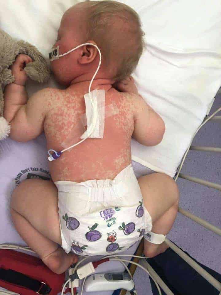 Bebê teve sarampo com apenas 11 meses