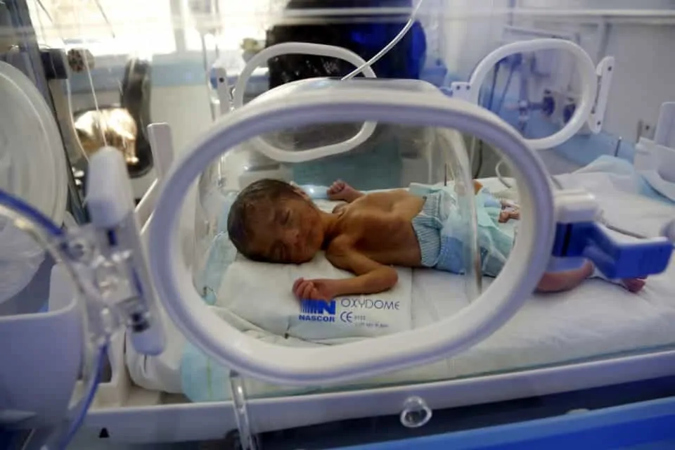 Bebê menino que ficou extremamente desnutrido no conflito