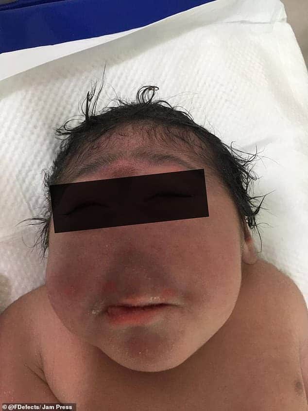 O bebê também nasceu com microcefalia 