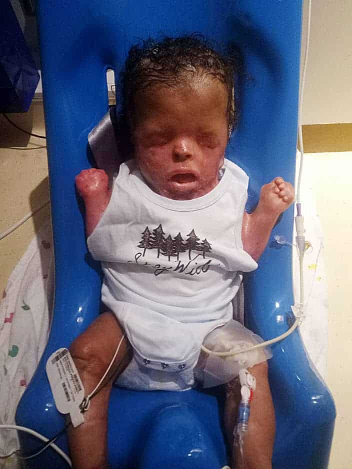 Bebê usando roupinha pela primeira vez após transplante de pele