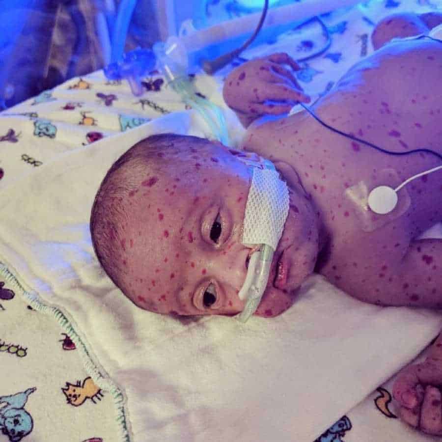 O bebê Dominic tem enfrentando após ter nascido com problemas raros
