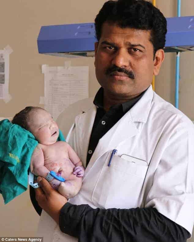 O Dr. Sanjay Bansode publicou essa foto com o bebê que nasceu com a rara síndrome