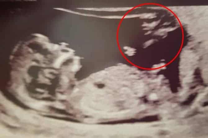 Ultrassom do bebê e a imagem que a mãe achou parecida com anjo