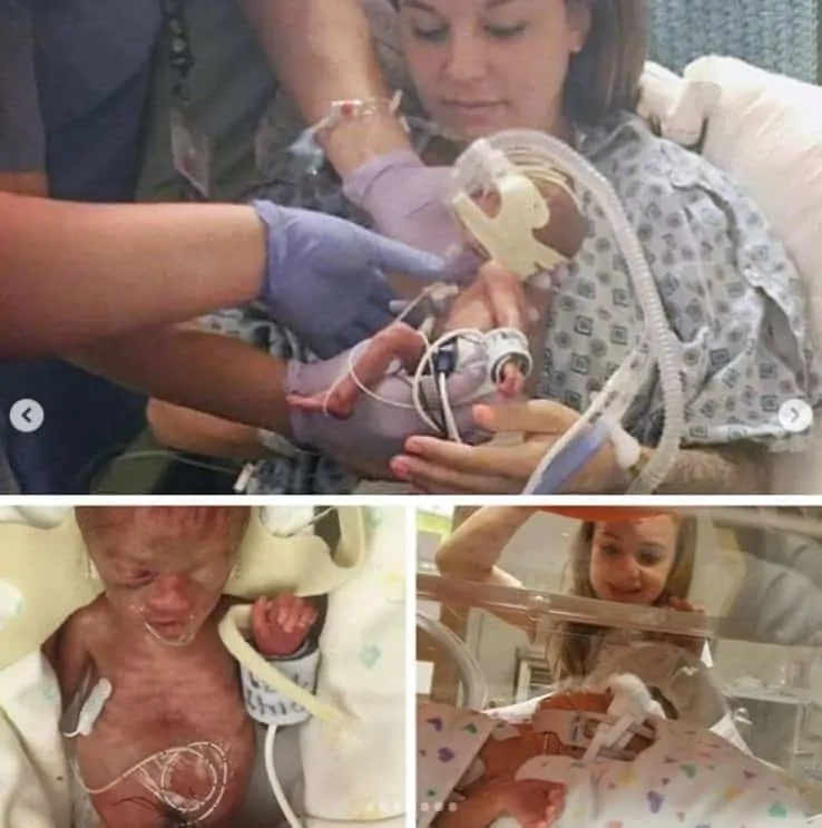 Bebê nasceu extremamente prematuro e superou expectativas