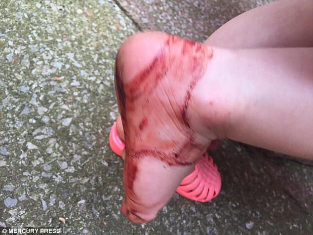 Sandália machuca pé de criança 