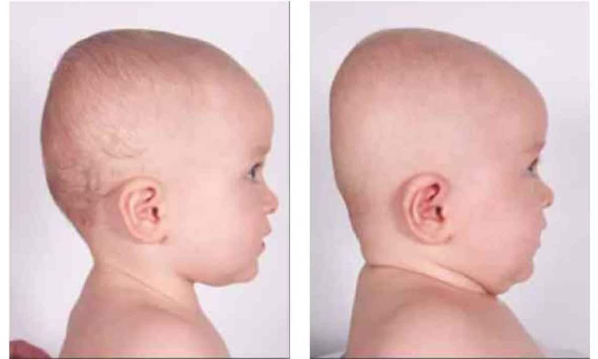 Plagiocefalia e braquicefalia: entenda a cabeça chata em bebês