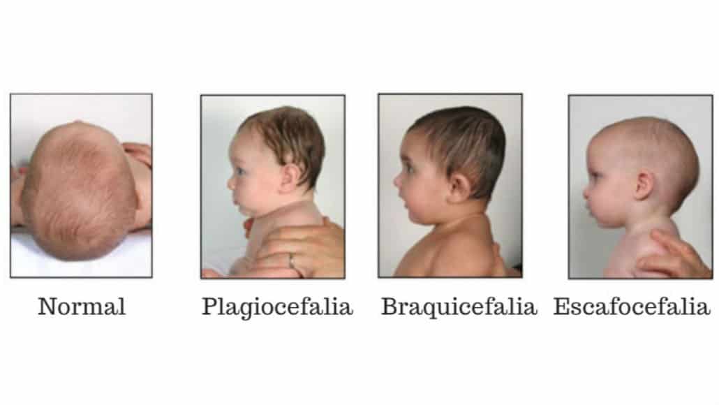  Plagiocefalia, Braquicefalia e Escafocefalia