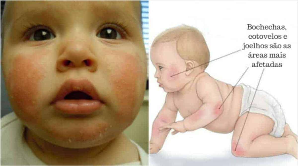 Aprender sobre 47+ imagem dermatite atópica em bebe fotos - br ...