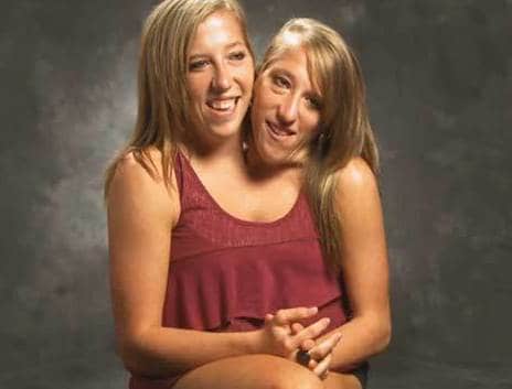 Essas gêmeas siamesas nasceram nos EUA