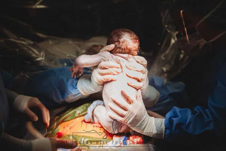 Pode se ver perfeitamente nessa imagem as mãos de Emily Dial puxando o seu filho durante o parto de cesárea