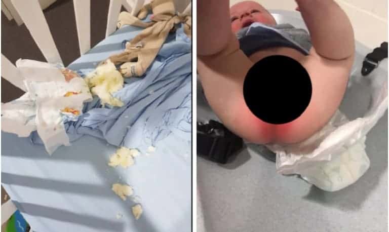 Imagem de como ficou a pele do bebê, após a fralda explodir