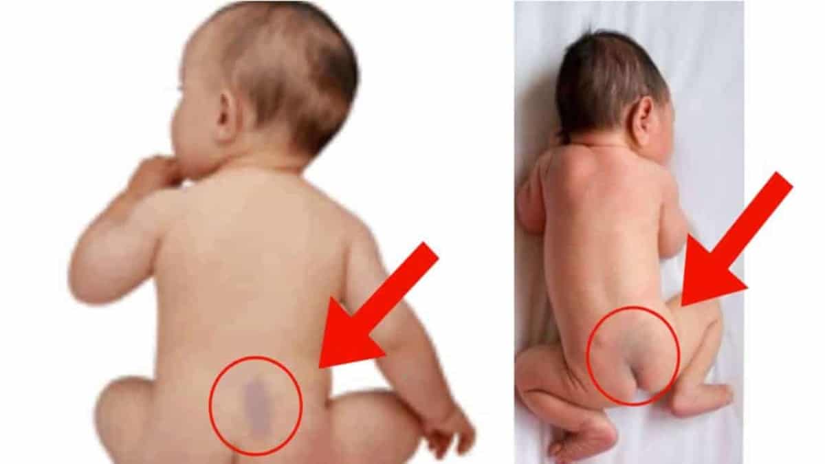 Porque os bebês nascem com o bumbum roxo?