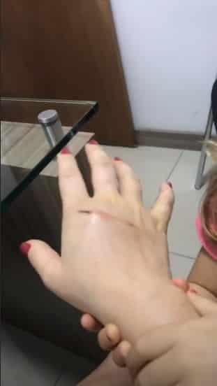 Imagem da mão de Mariana Bridi com o machucado