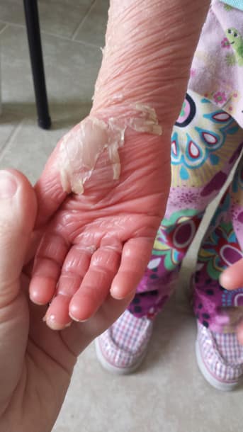Mãos da menina com doença de pele 