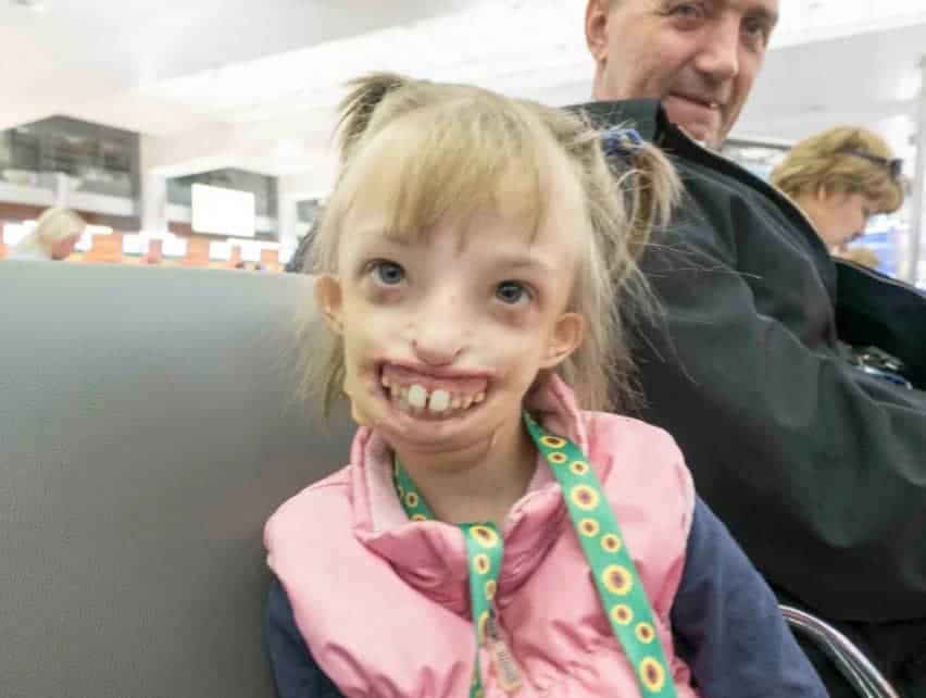 Menina sorrindo após ter feito cirurgia