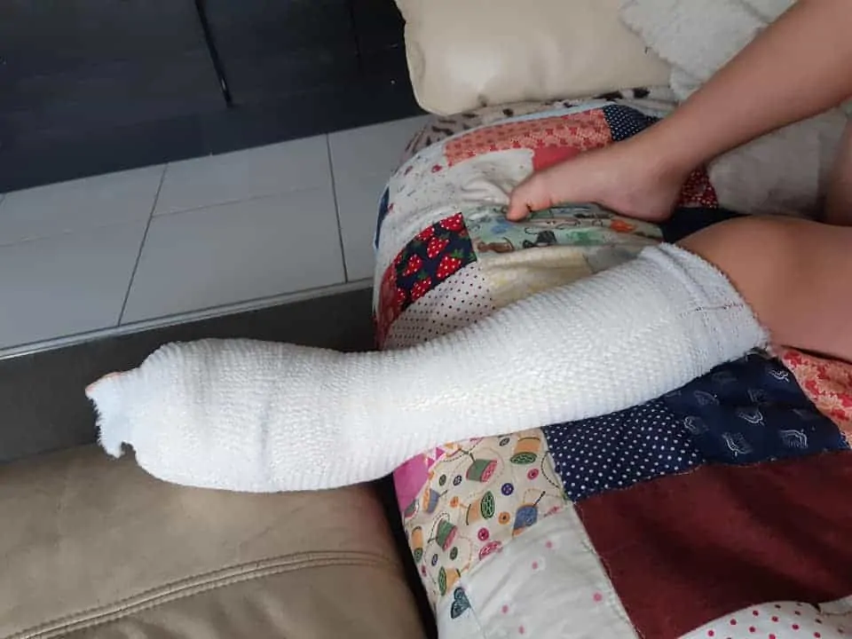 Menino de cinco anos com pé enfaixado após queimadura
