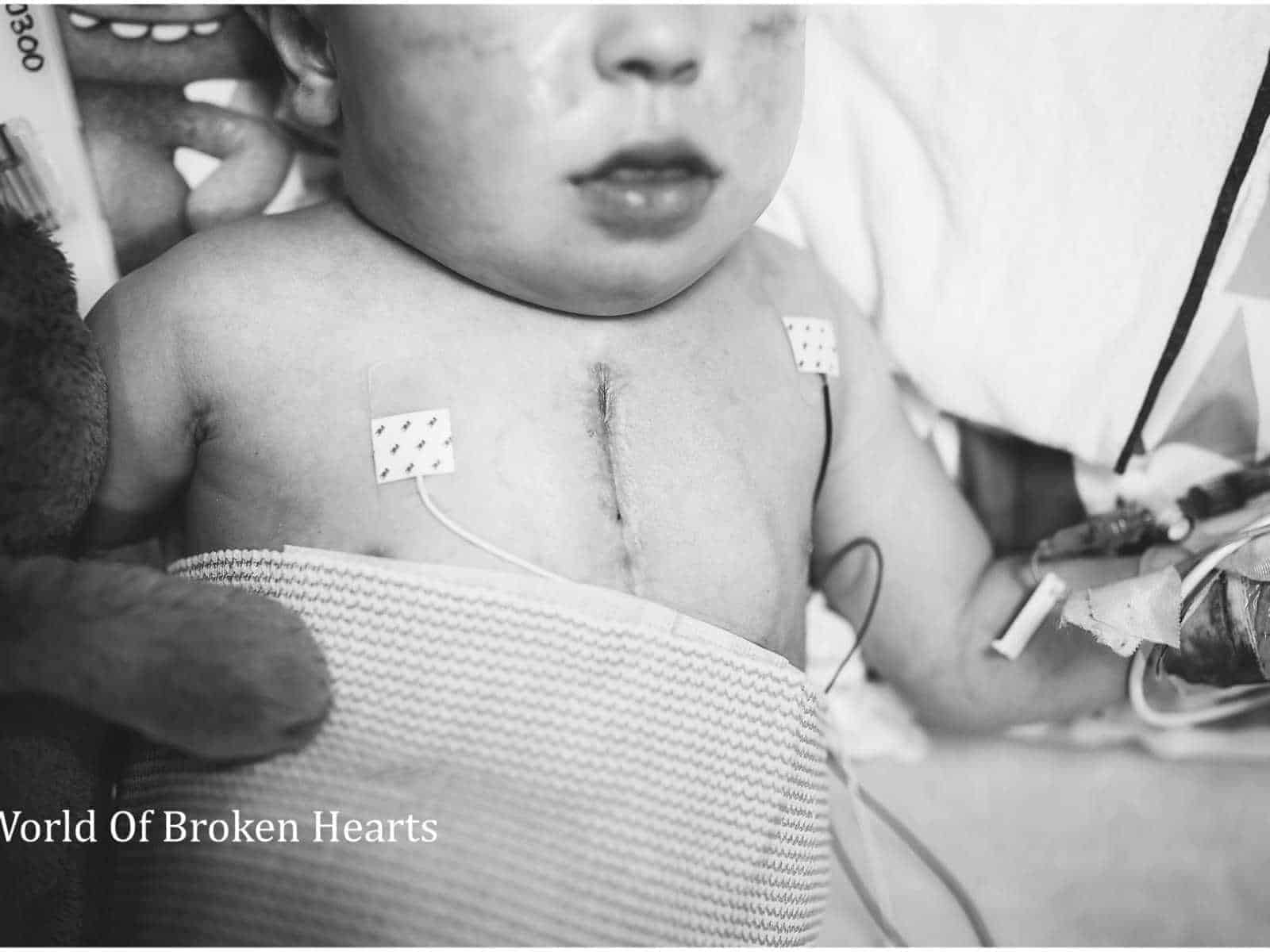 Foto da cicatriz no peito da bebê Adalynn