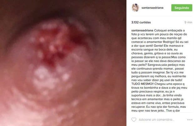 Adriana Sant’Anna posta foto do mamilo machucado