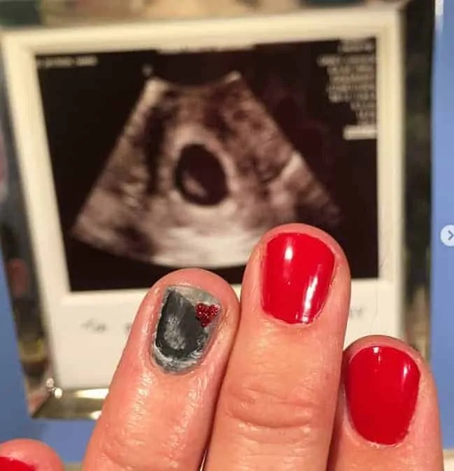 O ultrassom do bebê em unhas mais curtas 
