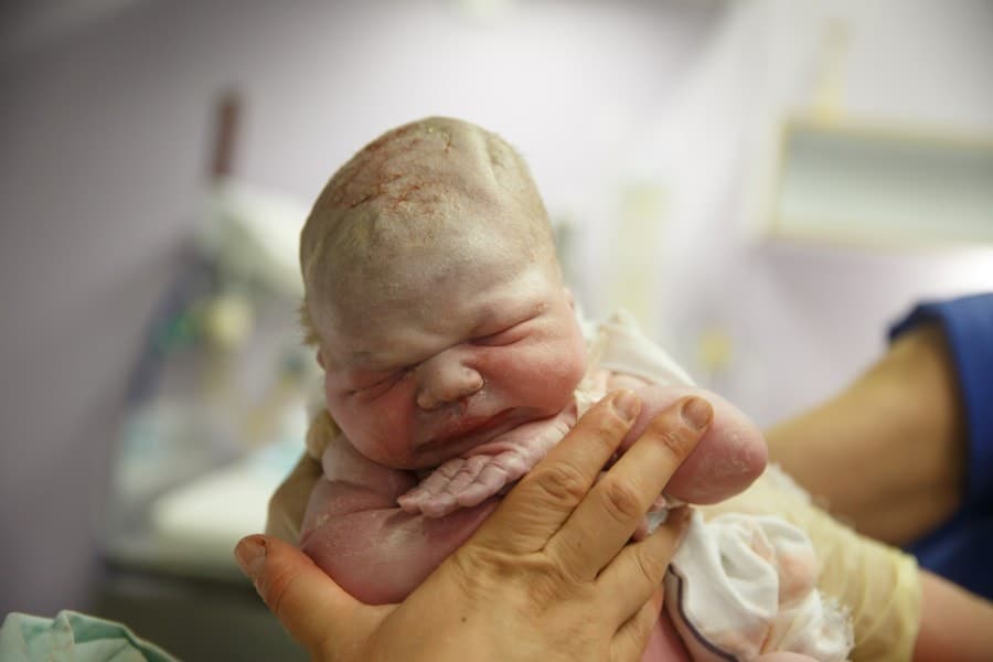 A prematuridade pode ser percebida na pele do bebê