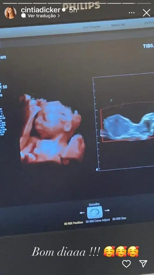 A pequena Aurora, bebê de Pedro Scooby e Cintia Dicker, na primeira imagem de ultrassom 