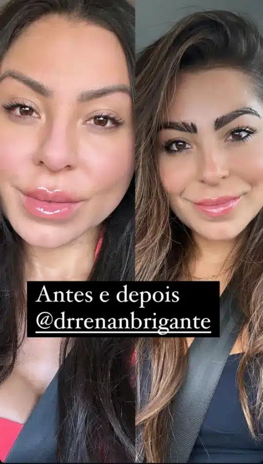 Andressa Ferreira mostra antes e depois, após transplante de sobrancelhas