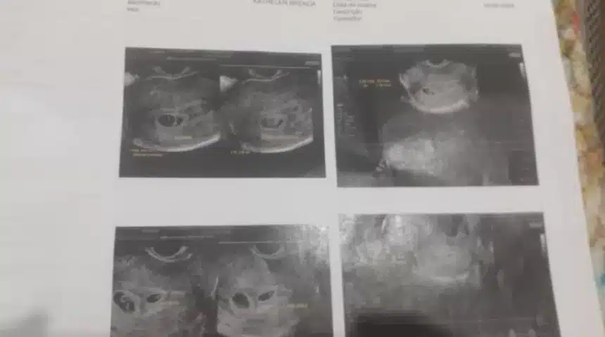 Ultrassom que dizia que Kathelen teria gêmeas