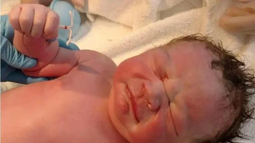 Bebê que veio ao mundo com o DIU de sua mãe