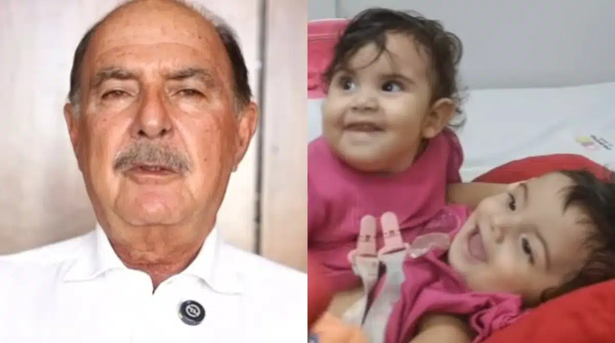 Médico falou do estado das gêmeas siamesas