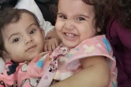 Pais mostraram gêmea que sobreviveu a separação de sua irmã