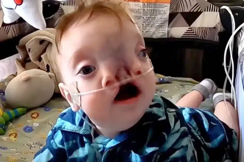 Bebê Brody poderá se alimentar após o primeiro procedimento