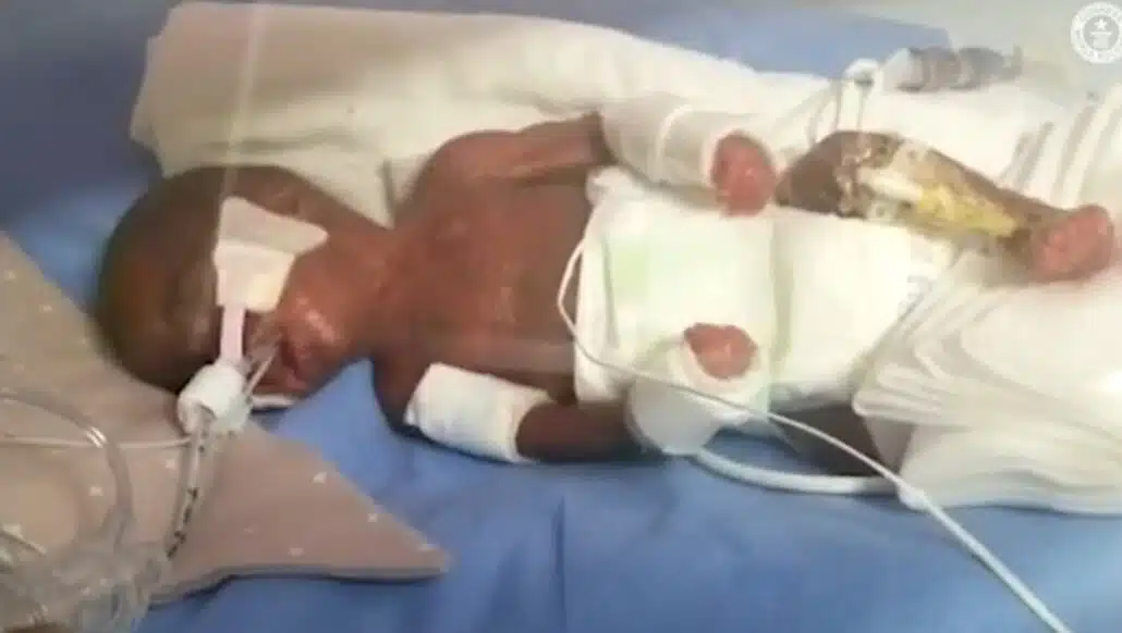 Um dos bebês pouco após ter vindo ao mundo