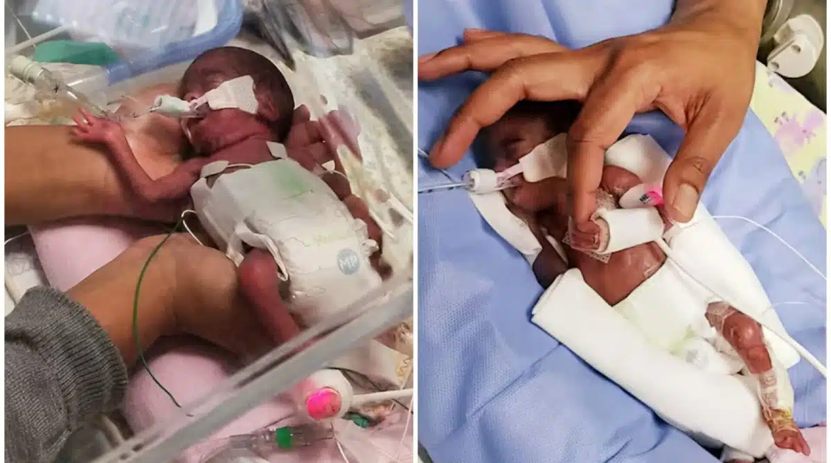 Gêmeos mais prematuros do mundo comemoraram seu terceiro aniversário