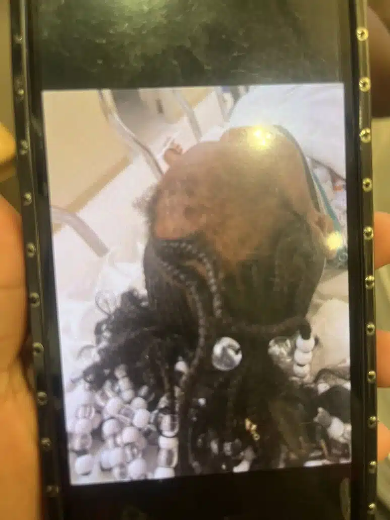 Menina de 5 anos após o ocorrido