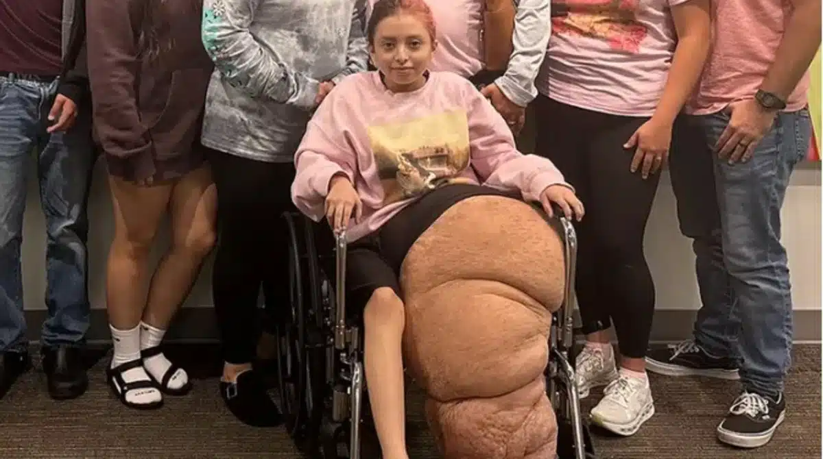 Adolescente exibiu transformação depois de ter operado a perna