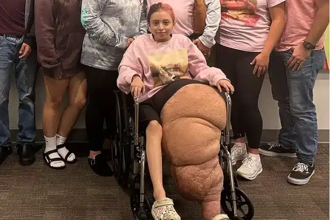 Adolescente mostrou como ficou