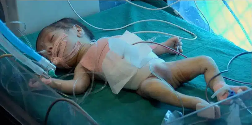 Bebê Sonni depois do seu irmão ter sido tirado