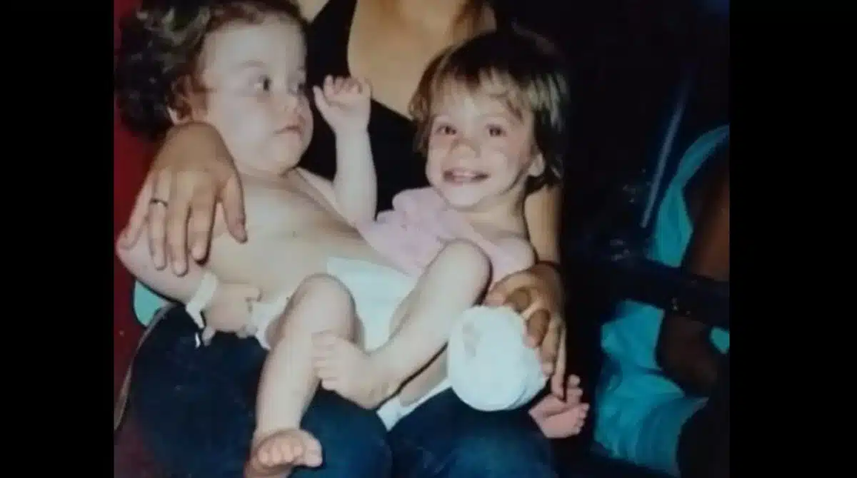 Gêmeas siamesas revelaram como estão