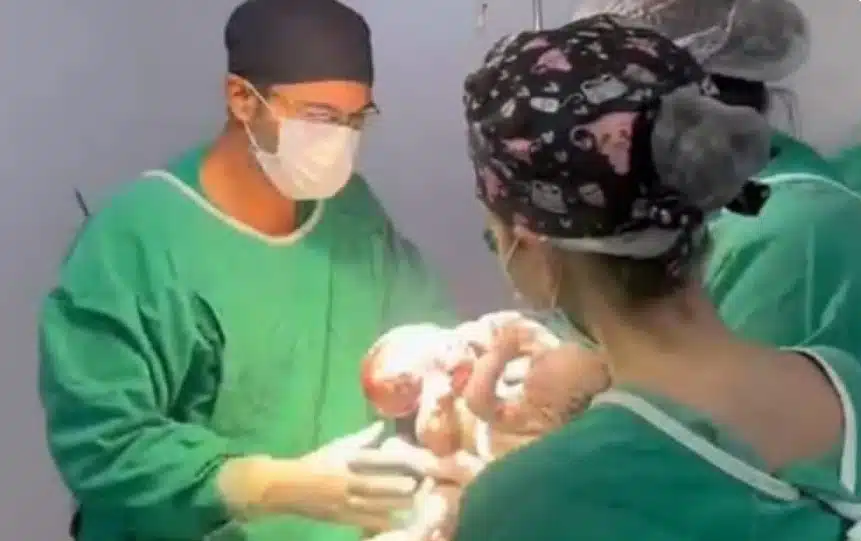 Gêmeos siameses durante o nascimento