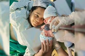 Gêmeos siameses com a mãe durante o nascimento