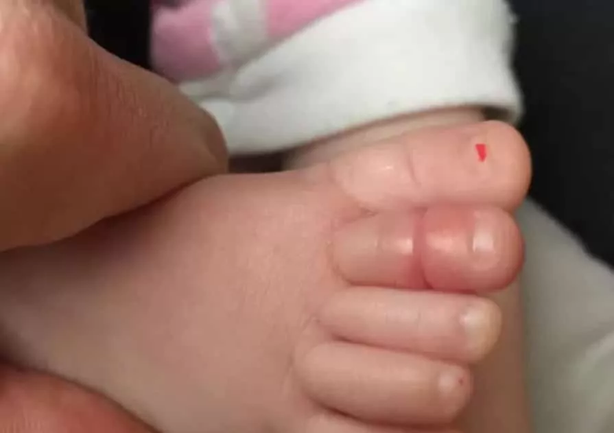 Pezinho do bebê diante da Síndrome do Torniquete de Cabelo