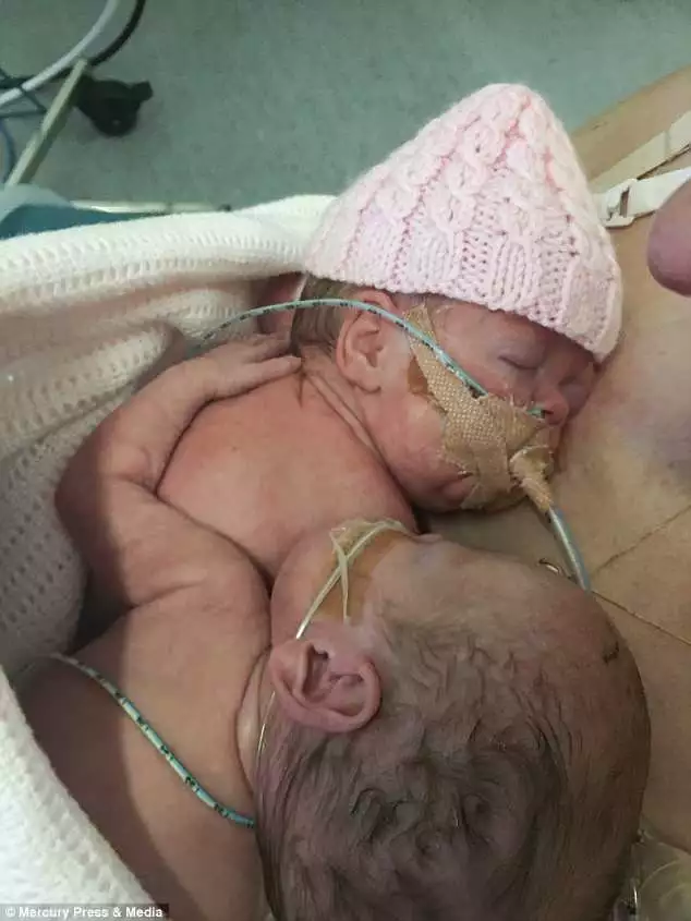 Bebê se despede de gêmea que morreu