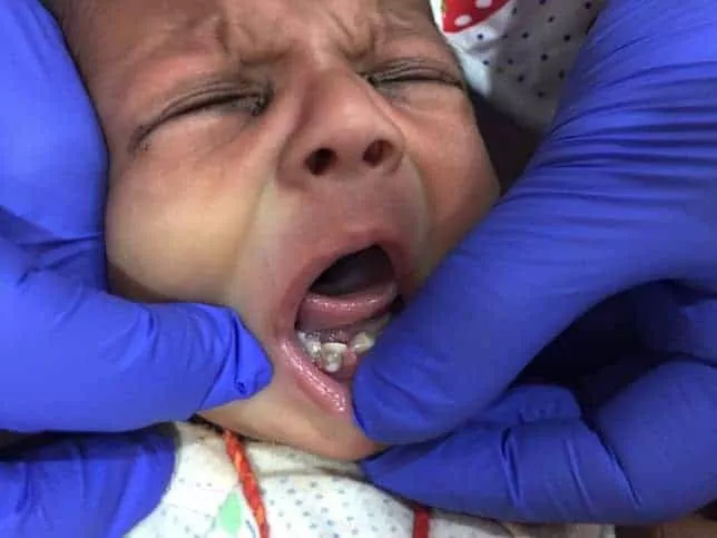 Recém-nascido com sete dentes