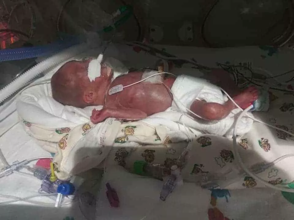 Bebê internada depois do parto extremamente prematuro