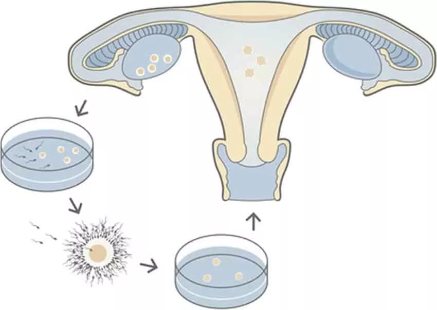 Fertilização in vitro (FIV): o que é, como funciona, riscos e indicações