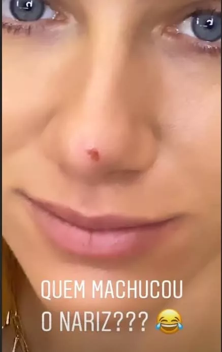 Giovanna Ewbank mostrando o nariz machucado