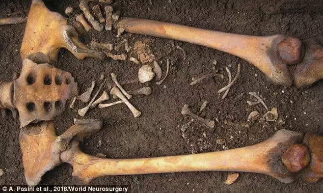 Veja os ossos do bebê que nasceu após sua mãe morrer